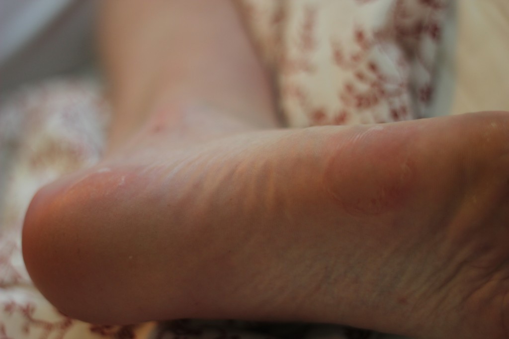 Blisters